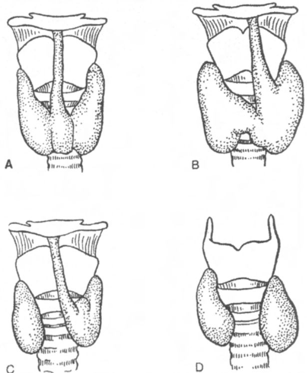 Необычные формы щитовидной железы